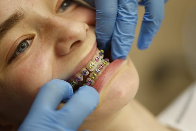 A teenage patient with fixed braces and colourful orthodontic modules