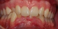 SK before fixed braces