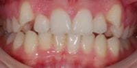 Francesca's teeth before treatment