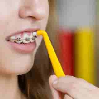 Interdental brushes used by an orthodontics patient with fixed braces