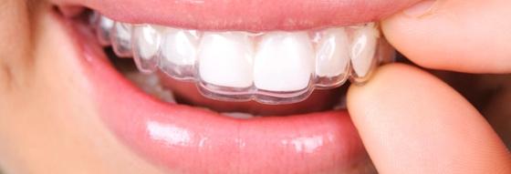 Close up on Invisalign clear aligners fitting to upper teeth