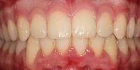 RA's teeth after orthodontics