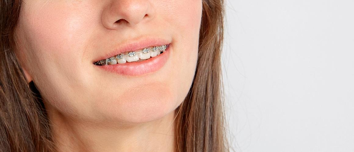 Smiling invisalign patient holding her clear aligners